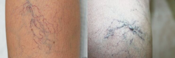 Symptômes de varices