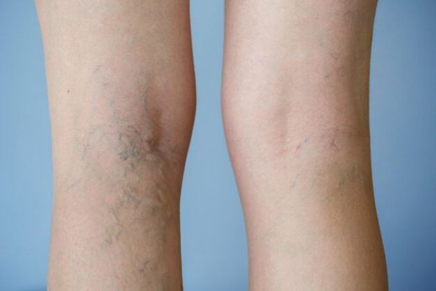 Varices