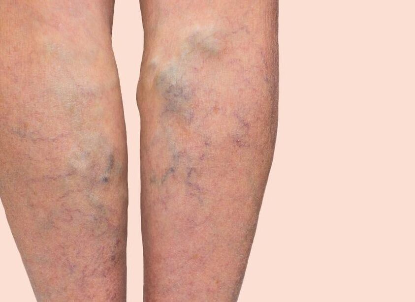 À quoi ressemblent les varices