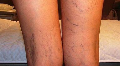 Comment traiter l'expansion du varicon des femmes chez les femmes