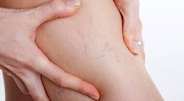 Signes et symptômes de varices