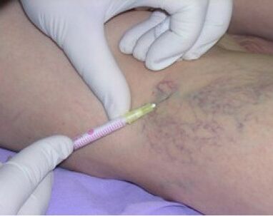 Injections contre les varices