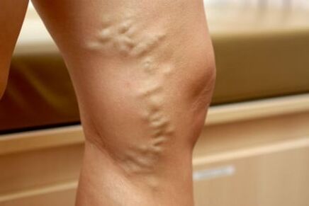 Médicament contre les varices