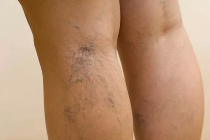 Pathologie veineuse des jambes