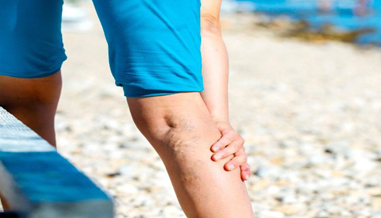 Douleur aux jambes avec varices