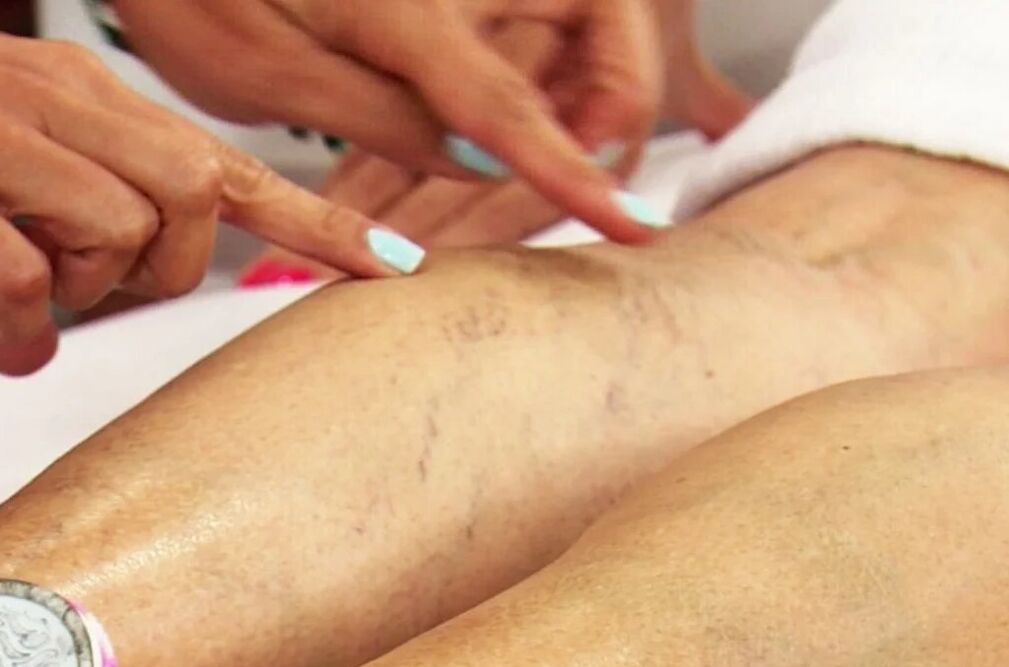 Examen des jambes avec varices