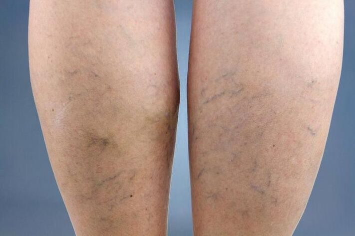 Symptômes de varices dans les jambes